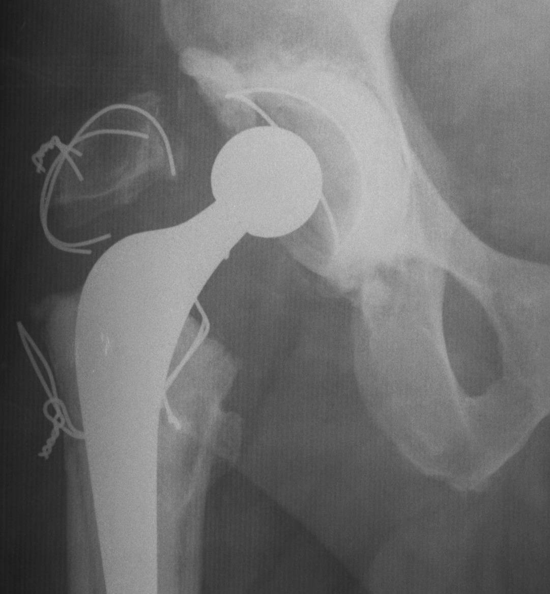 GT Osteotomy Broken Wire